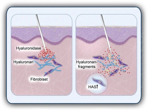 Hyaluronidase degrades dermal hyaluronan to improve ECM permeability and drug diffusion.