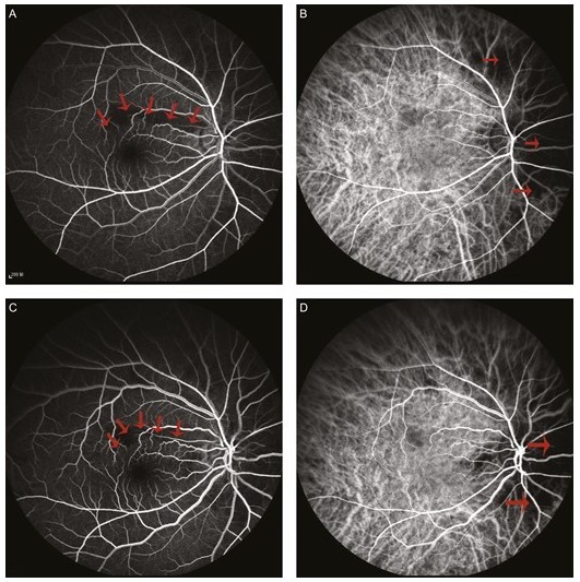 Endovascular hyaluronidase application through super selective angiography to rescue blindness caused by hyaluronic acid injection.