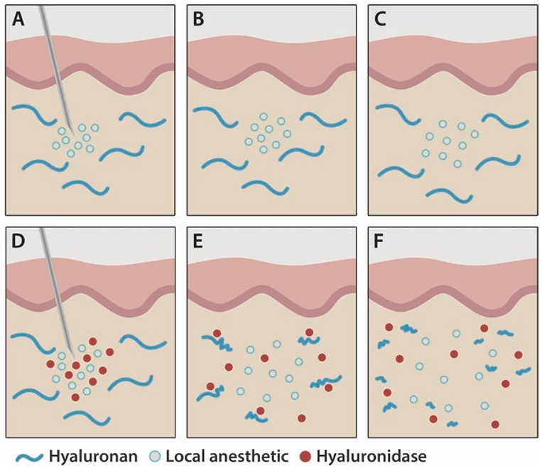 Mechanism of hyaluronidase to increase the bioavailability of injected drugs.