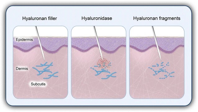 Hyaluronidase acts as a reverse hyaluronic acid filler.