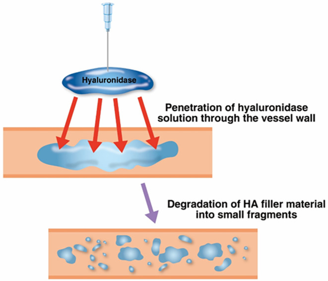 Hyaluronidase penetrates the vessel wall and degrades the hyaluronic acid filler into small fragments.