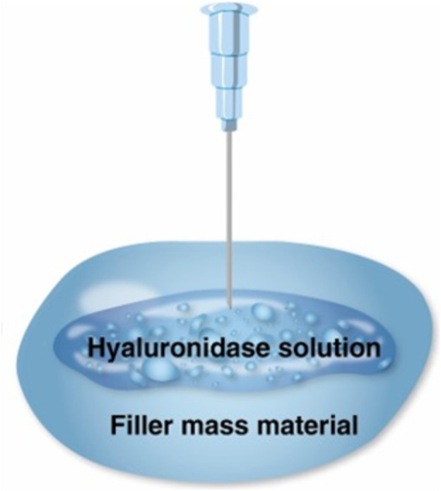 Hyaluronidase solution degrades filler mass material.
