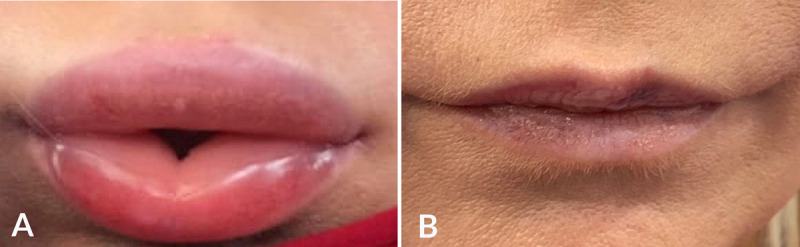 Hyaluronidase can be used to treat edema after hyaluronic acid filler overcorrection.