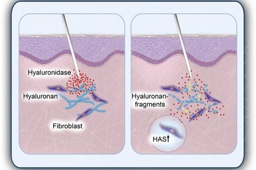Hyaluronidase: Beyond Fillers—Other Uses and Applications