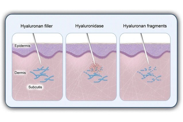 Hyaluronidase acts as a filler dissolver.