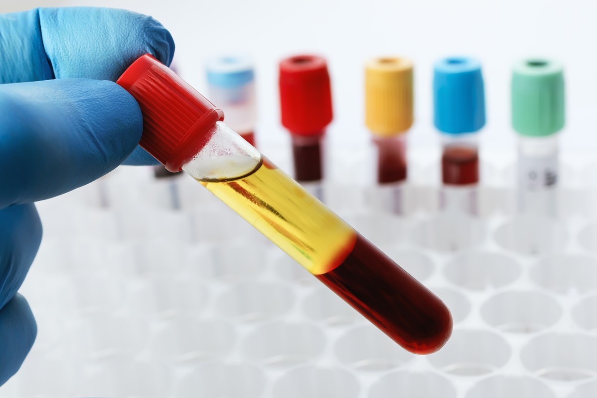 Testing for diamine oxidase levels in serum.