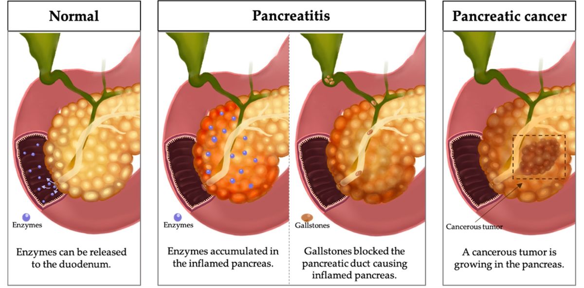 Pancreatin supplementation is required in clinical conditions such as pancreatitis and pancreatic cancer.