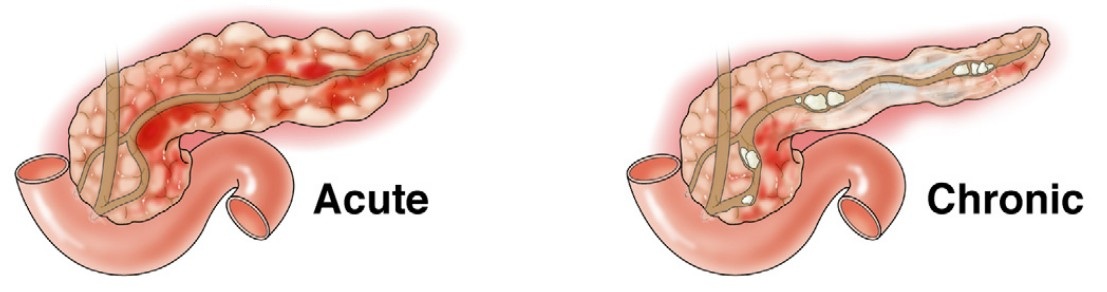 Acute and chronic forms of pancreatitis.