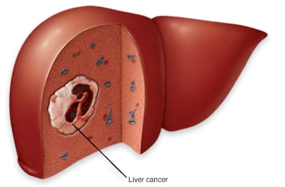 Liver cancer