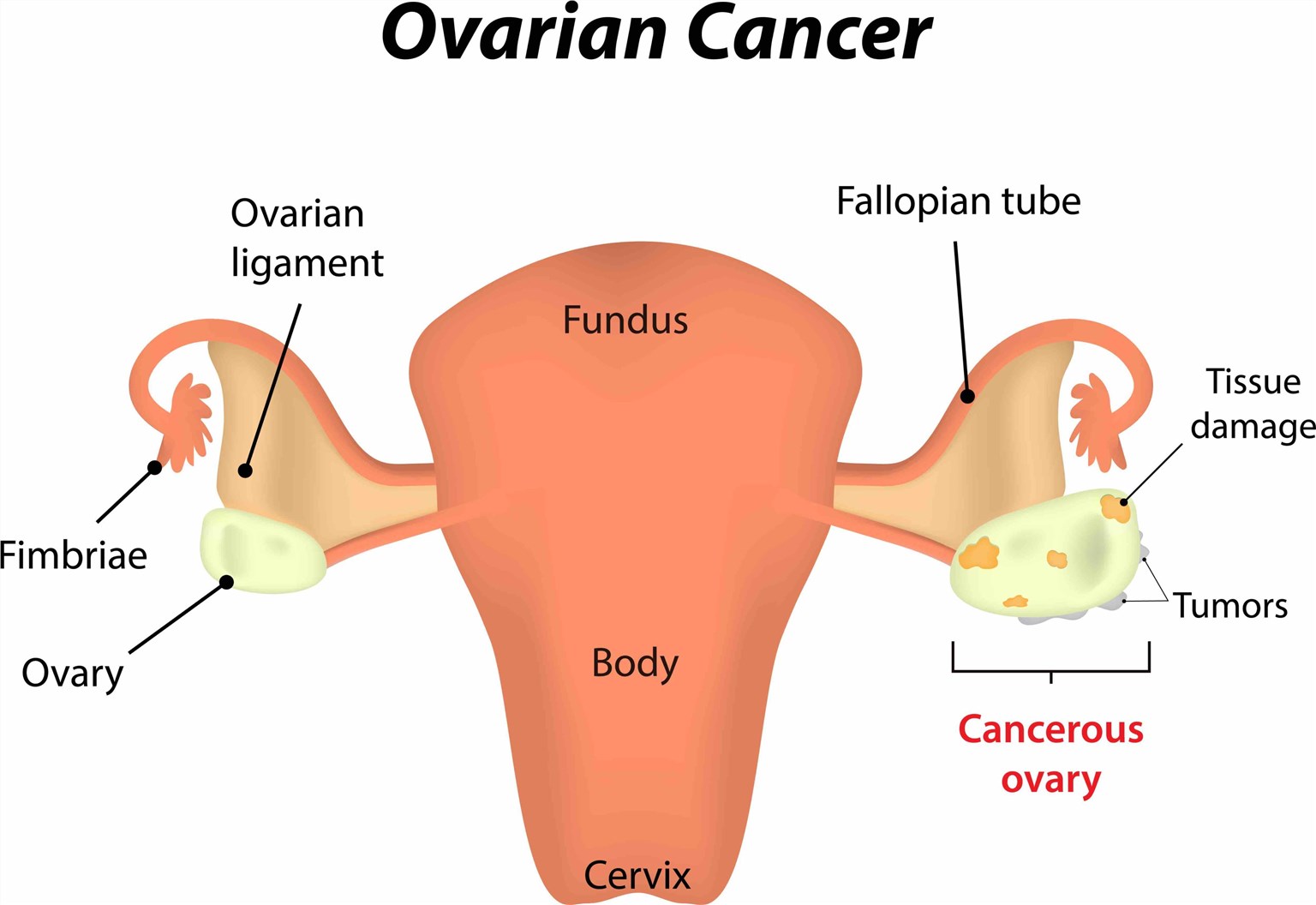 Ovarian cancer.