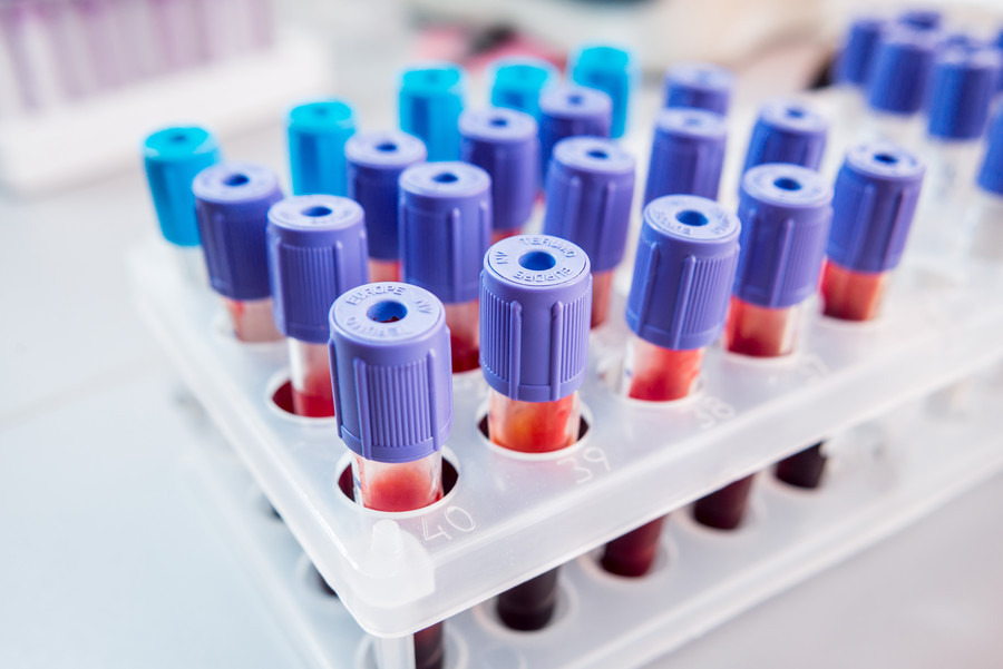 Recombinant Enzymes for Creatinine Diagnostics: Creatinase, Sarcosine Oxidase & Creatininase